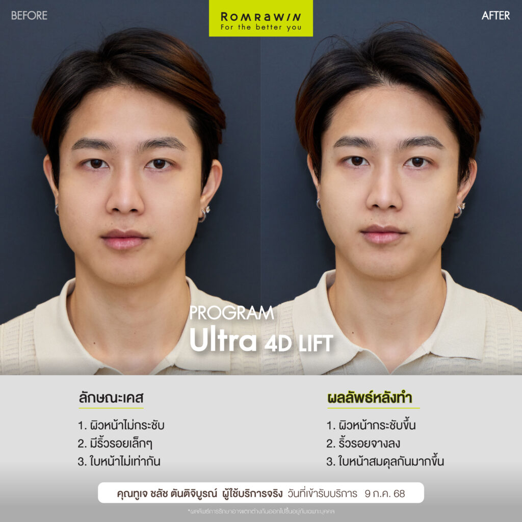 Lift & Renew 2 Combo ดแลผิวหน้าคุณทูเจ ชลัชให้จึ้ง 