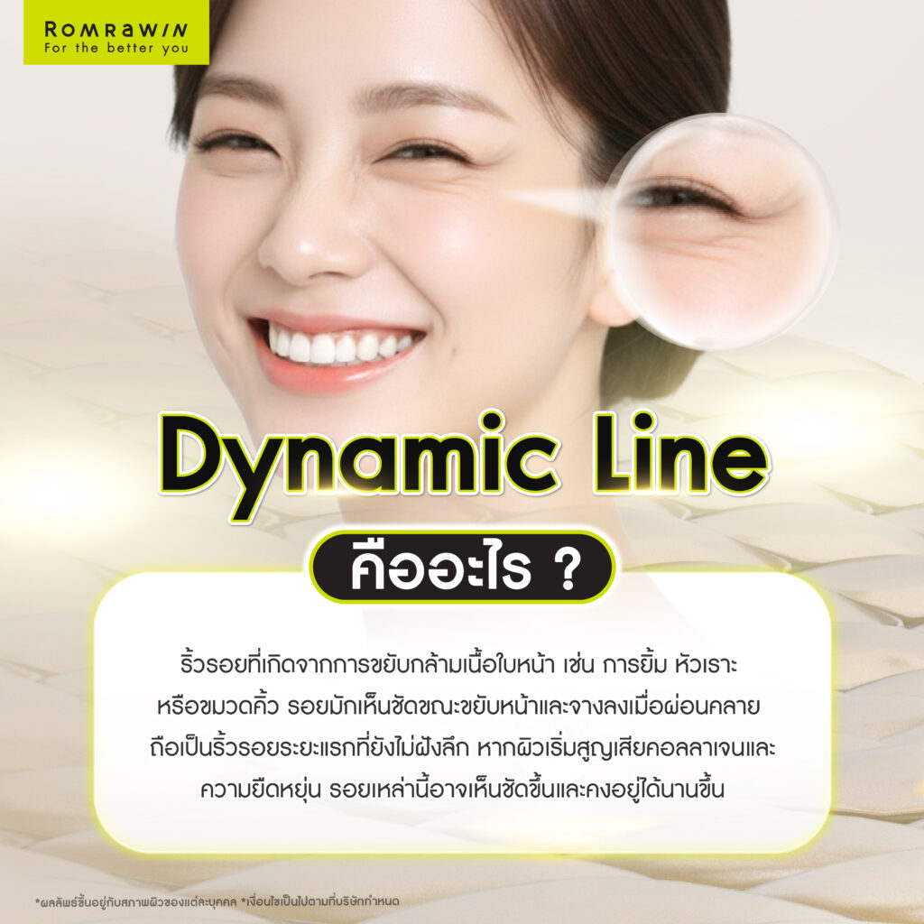 Dynamic Line คืออะไร ต่างจาก Static Line อย่างไรในเชิงโครงสร้างผิว 2 Dynamic Line คืออะไร