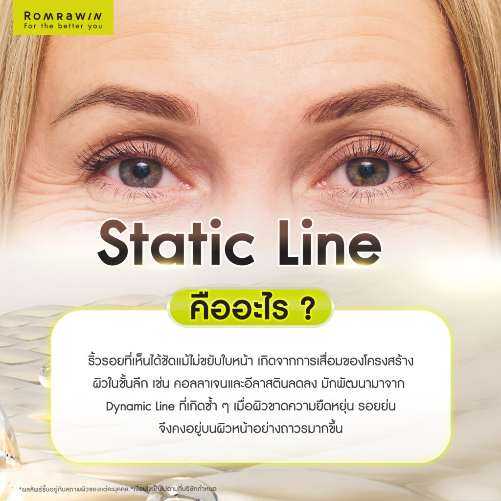 Dynamic Line คืออะไร ต่างจาก Static Line อย่างไรในเชิงโครงสร้างผิว 3 Static Line คืออะไร