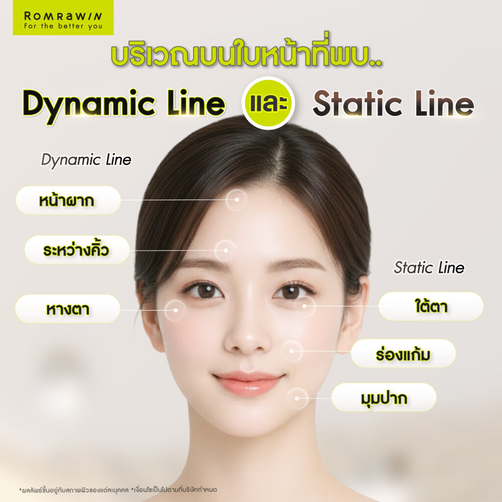 Dynamic Line คืออะไร ต่างจาก Static Line อย่างไรในเชิงโครงสร้างผิว 5 บริเวณบนใบหน้าที่มักพบ Dynamic Line และ Static Line