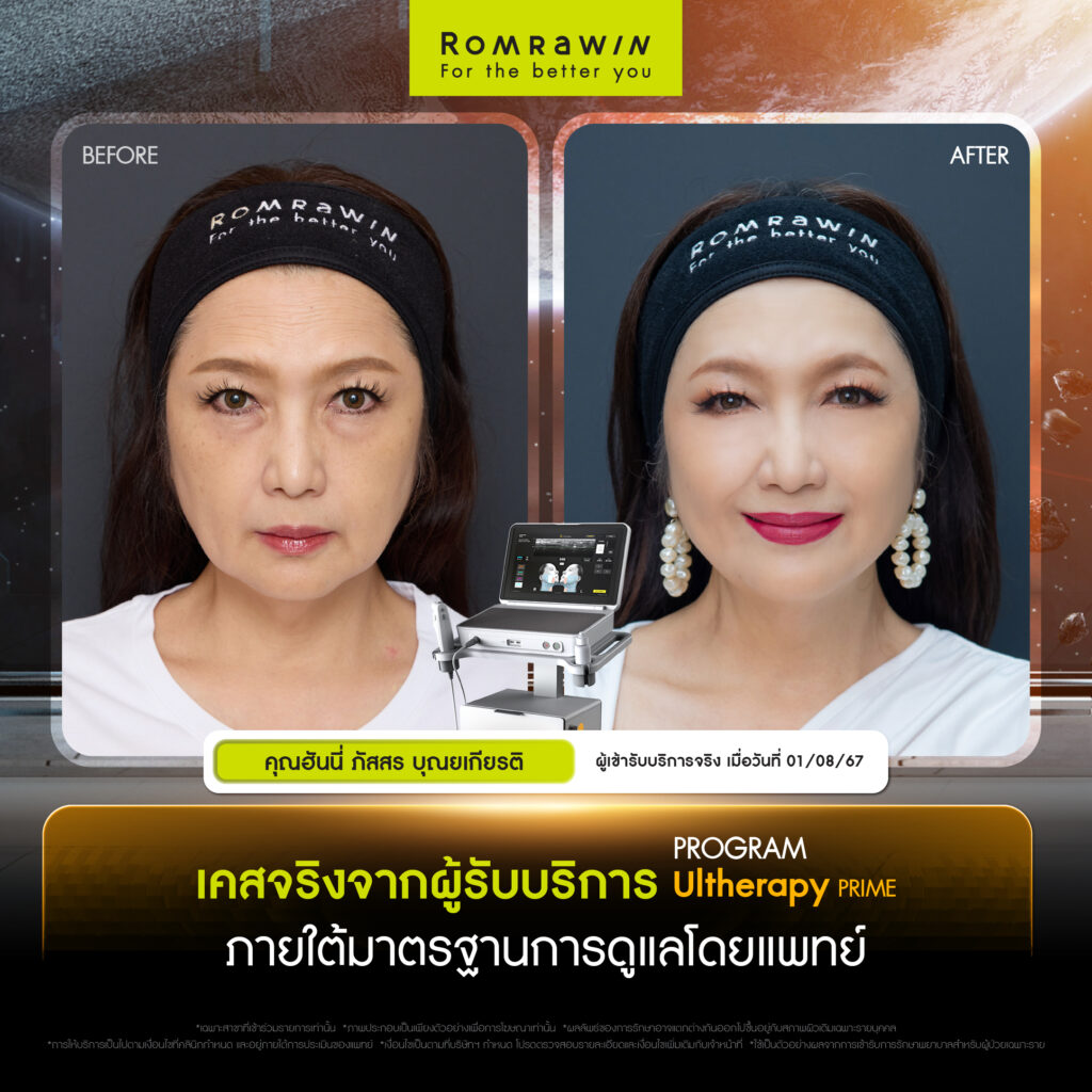 "คุณฮันนี่ - ภัสสร บุณยเกียรติ" เคสจริงจากผู้ใช้บริการจริง