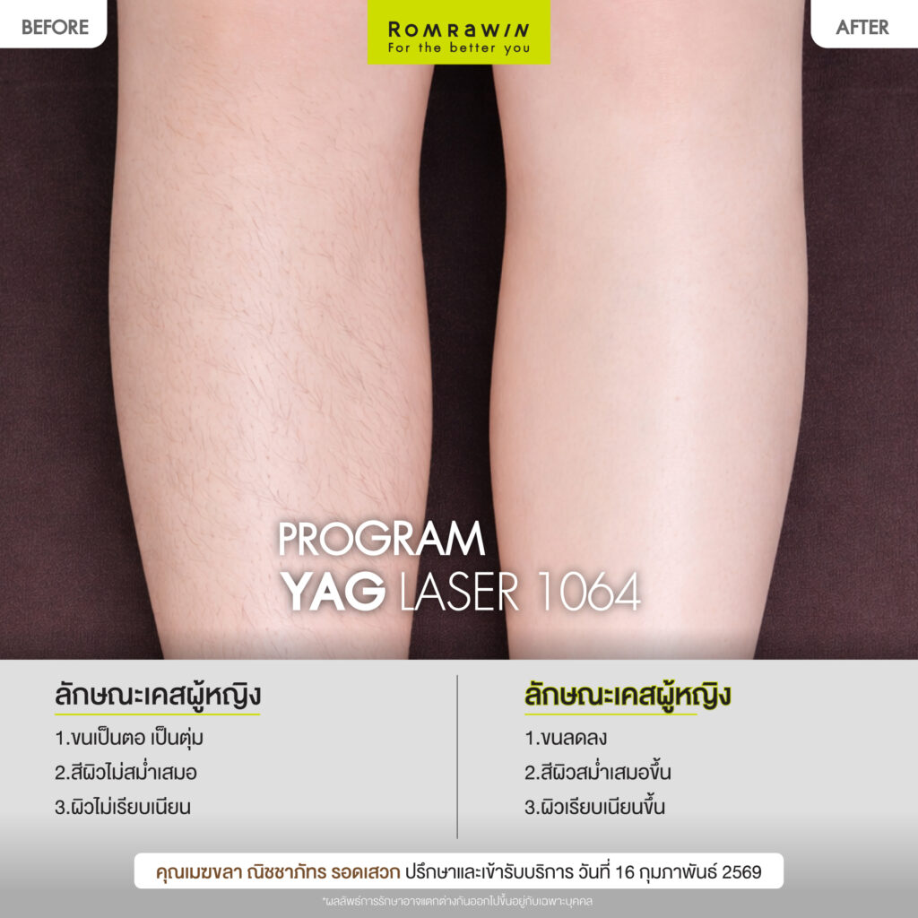 ผลลัพธ์ขึ้นอยู่กับแต่ละบุคคล