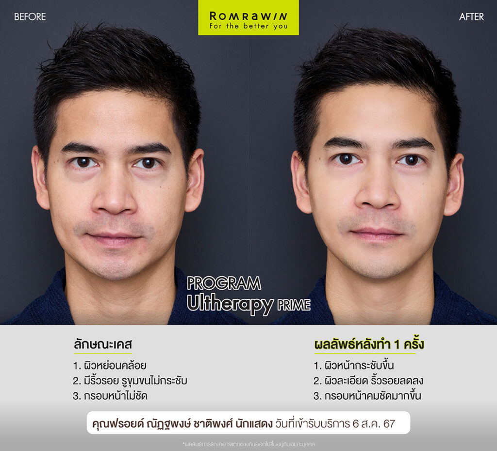 ผลลัพธ์ขึ้นอยู่กับแต่ละบุคคล