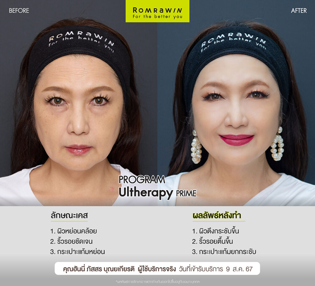 ผลลัพธ์ขึ้นอยู่กับแต่ละบุคคล