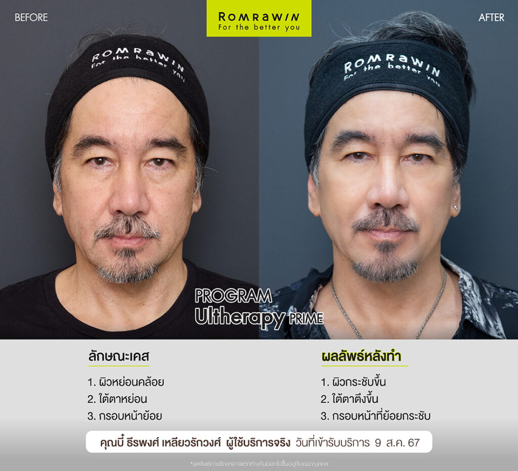 ผลลัพธ์ขึ้นอยู่กับแต่ละบุคคล