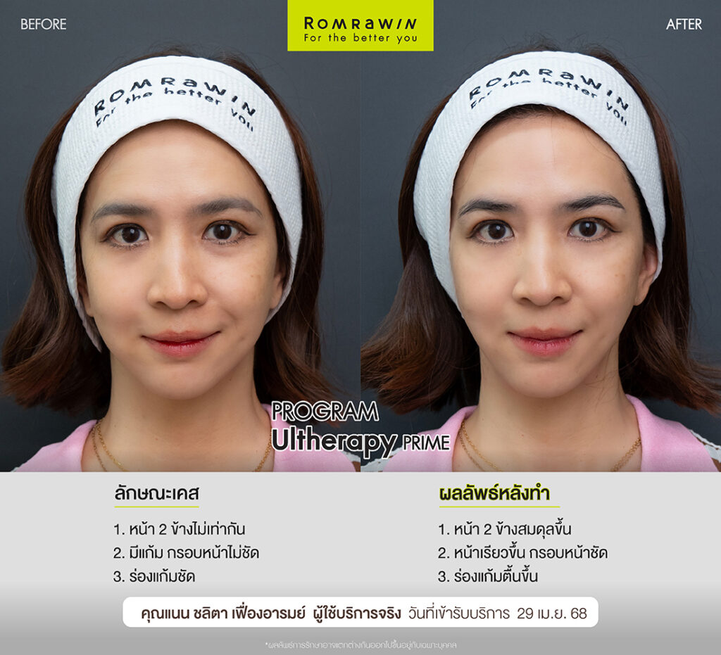 ผลลัพธ์ขึ้นอยู่กับแต่ละบุคคล