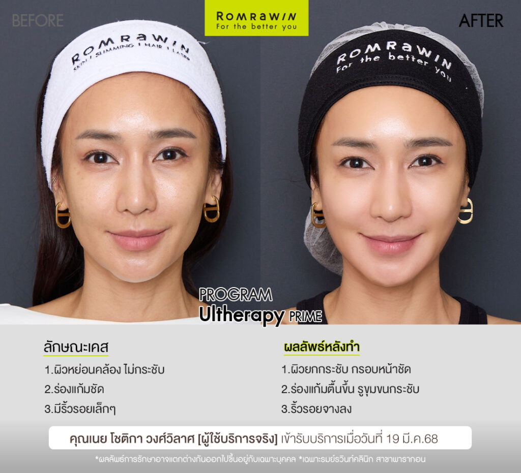ผลลัพธ์ขึ้นอยู่กับแต่ละบุคคล