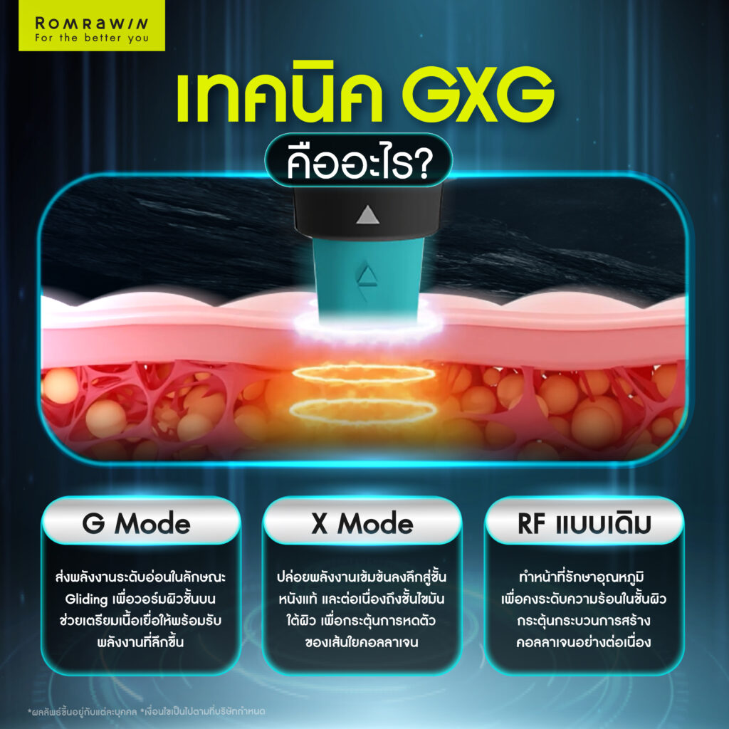 เทคนิค GXG ใน Oligio X ทำไมแตกต่างจาก RF แบบเดิม 2 เทคนิค GXG ใน Oligio X คืออะไร