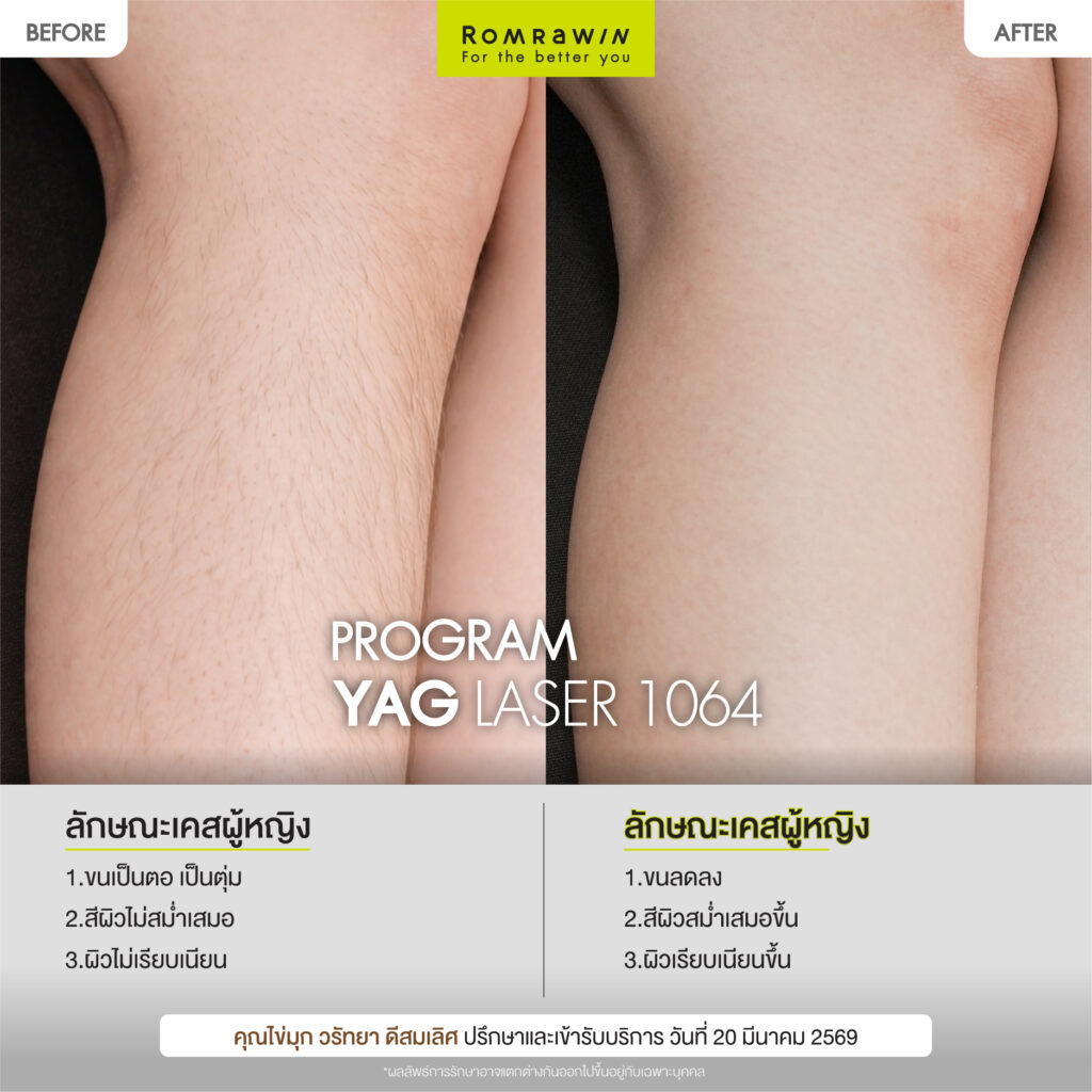 ผลลัพธ์ขึ้นอยู่กับแต่ละบุคคล