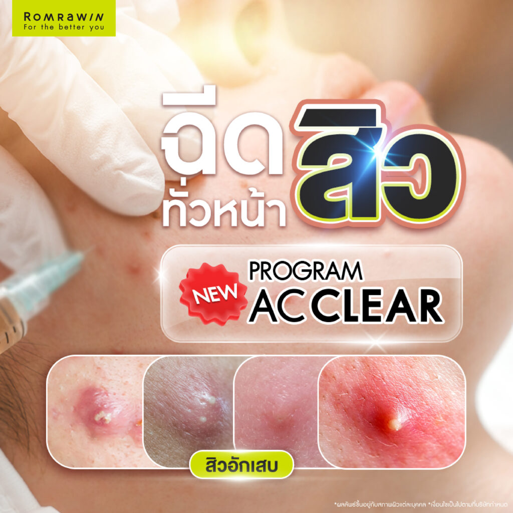 ฉีดสิวทั่วใบหน้า