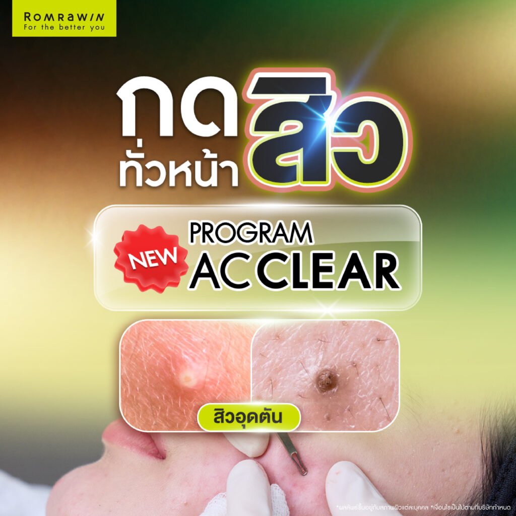 กดสิวทั่วใบหน้า