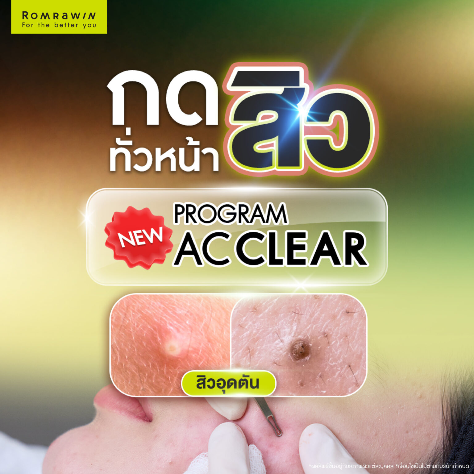 กดสิวทั่วใบหน้า
