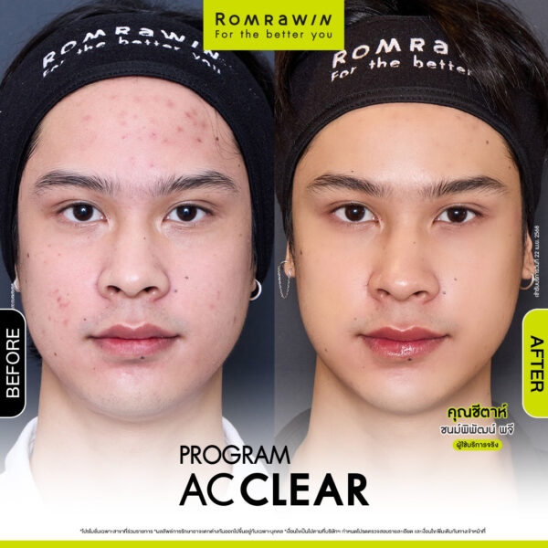 AC CLEAR คุณชีต้า