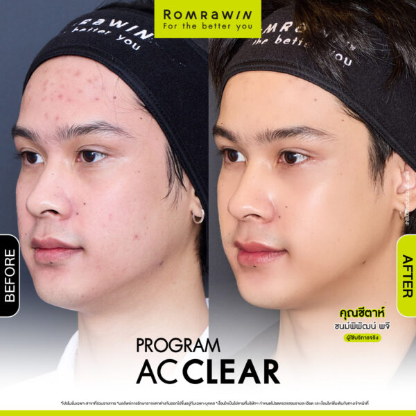 AC CLEAR คุณชีต้า