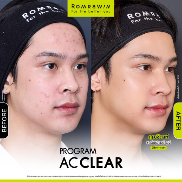 AC CLEAR คุณชีต้า