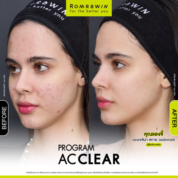 AC CLEAR คุณแองจี้