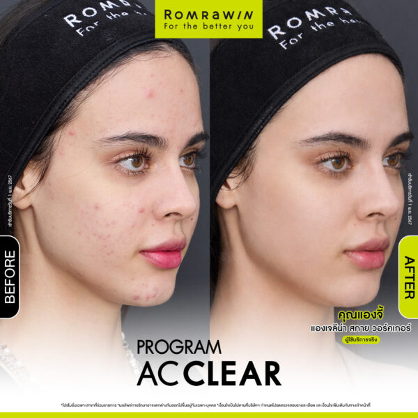AC CLEAR คุณแองจี้