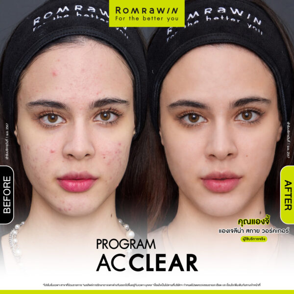AC CLEAR คุณแองจี้