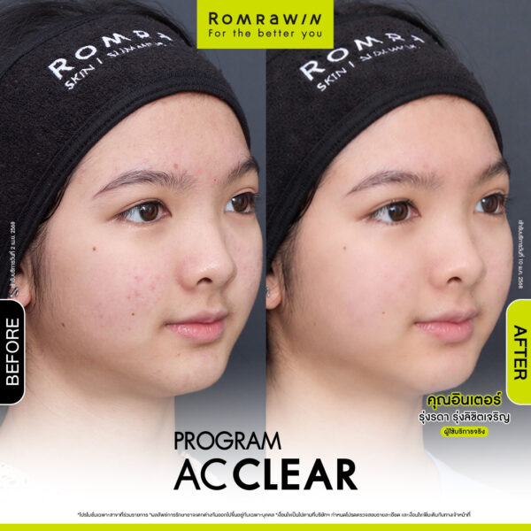 AC CLEAR คุณอินเตอร์