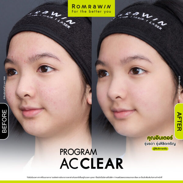 AC CLEAR คุณอินเตอร์