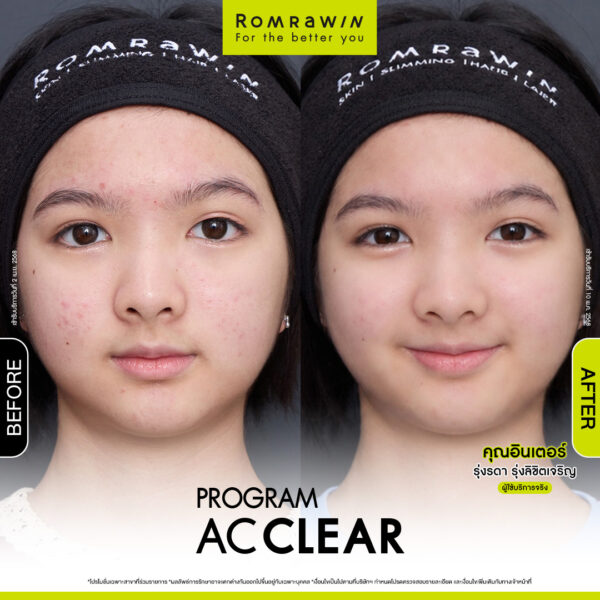 AC CLEAR คุณอินเตอร์