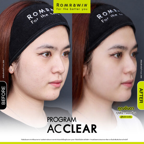 AC CLEAR คุณอันดา