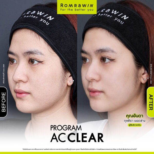 AC CLEAR คุณอันดา