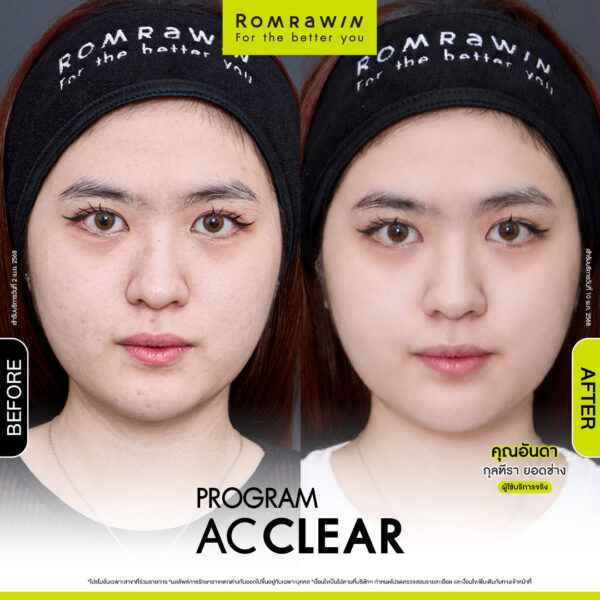 AC CLEAR คุณอันดา