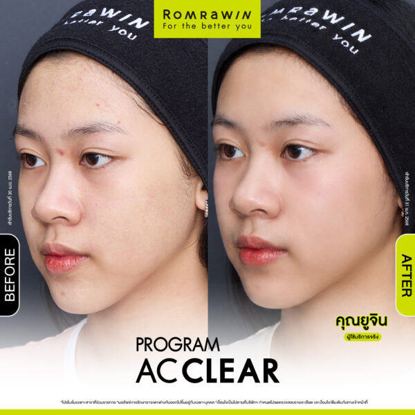 AC CLEAR ยูจิน
