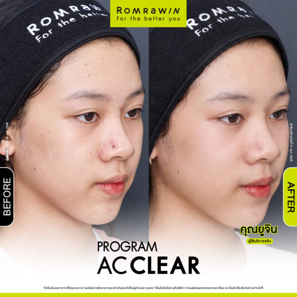 AC CLEAR ยูจิน
