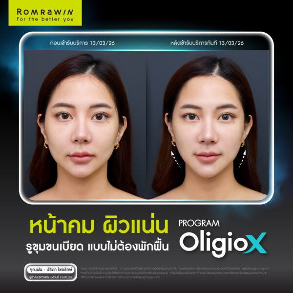 G Mode เทคโนโลยีสร้างงานผิว ใน Oligio X เพื่อผลลัพธ์ที่ดีกว่า 3 Oligio X G Mode