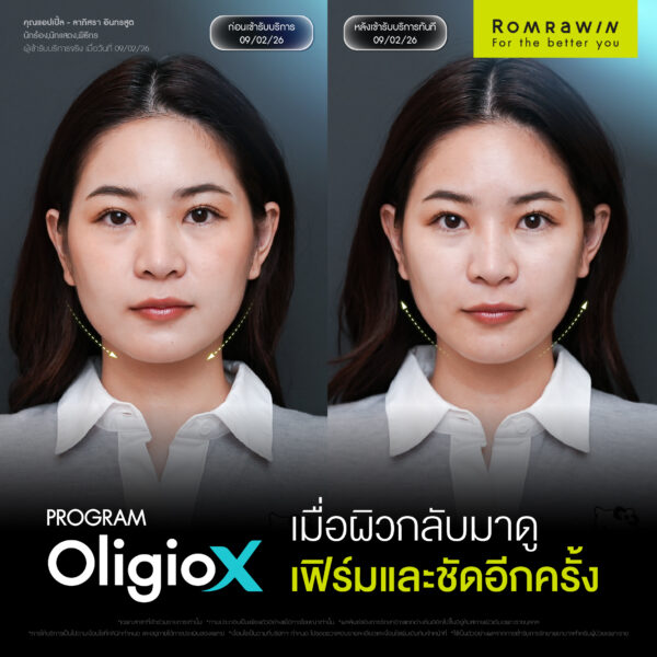 G Mode เทคโนโลยีสร้างงานผิว ใน Oligio X เพื่อผลลัพธ์ที่ดีกว่า 7 Oligio X