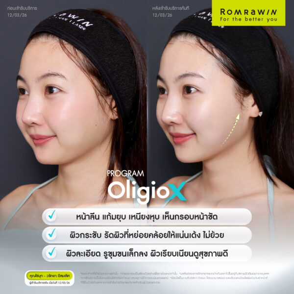 G Mode เทคโนโลยีสร้างงานผิว ใน Oligio X เพื่อผลลัพธ์ที่ดีกว่า 5 G Mode ไข่มุก
