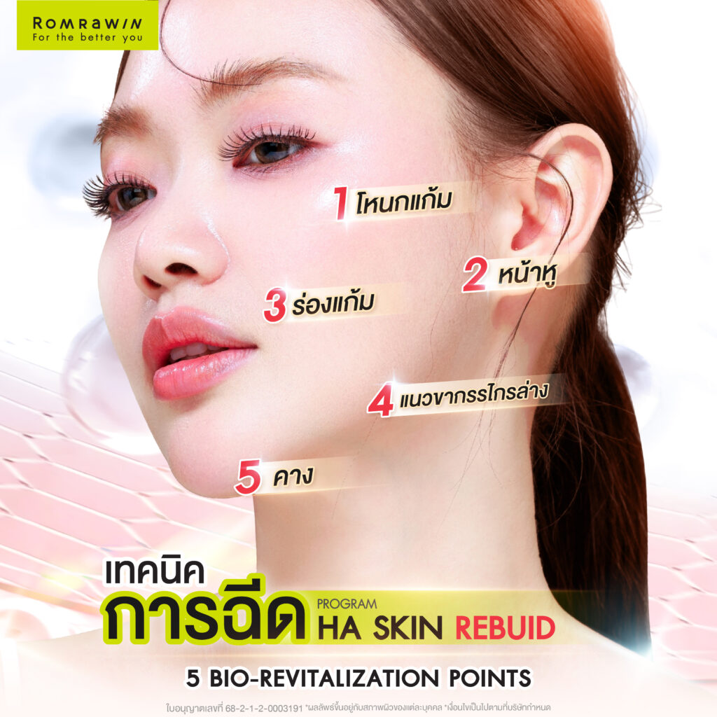 เทคนิคการฉีด Ejal40 แบบ 5 Bio-Revitalization Points