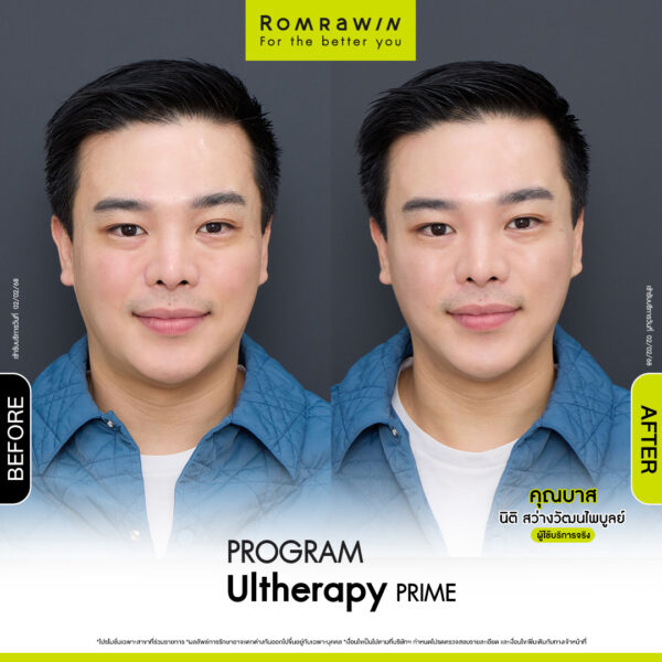 Review ulthera prime คุณบาส