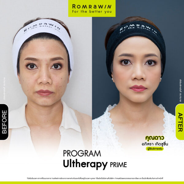 Review ulthera prime คุณดาว
