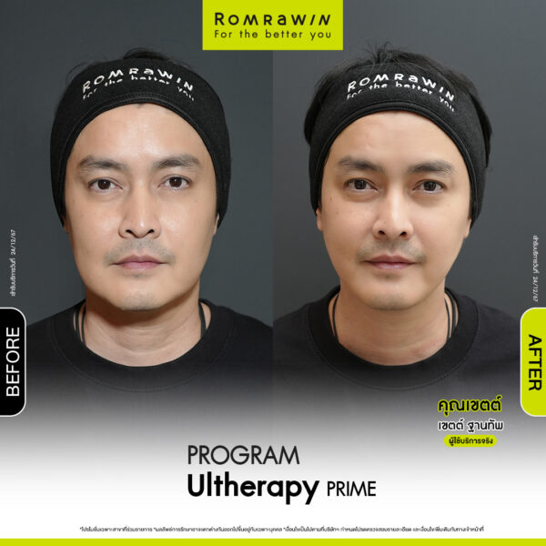 Review ulthera prime คุณเขต
