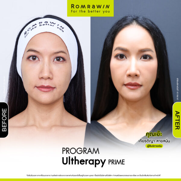 Review ulthera prime คุณเอ๊ะ
