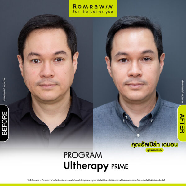 Review ulthera prime คุณอัลเบิร์ท