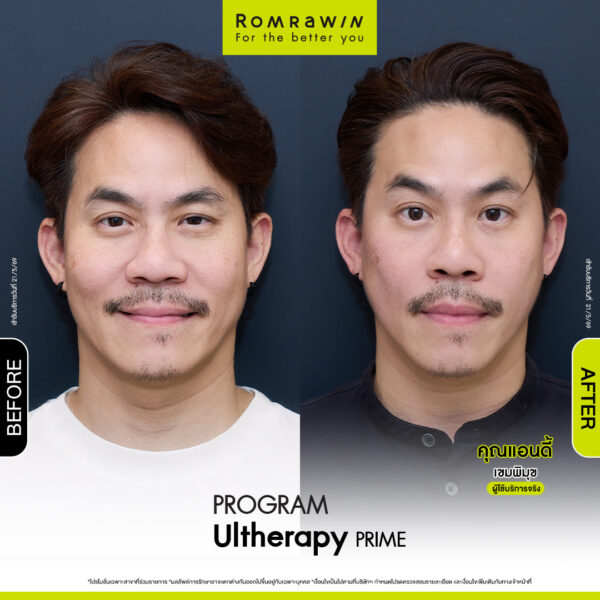 Review ulthera prime คุณแอนดี้