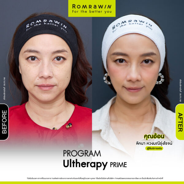 Review ulthera prime คุณอ้อน