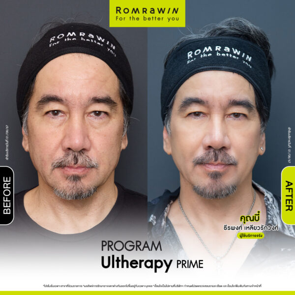 Review ulthera prime คุณบี๋