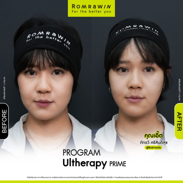 Review ulthera prime คุณเอิ๊ต