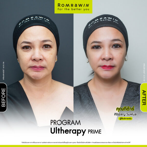 Review ulthera prime คุณกีตาร์