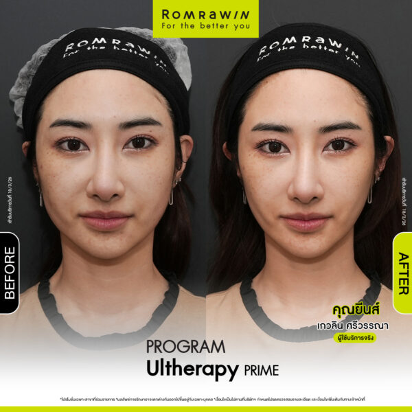 Review ulthera prime คุณยีน