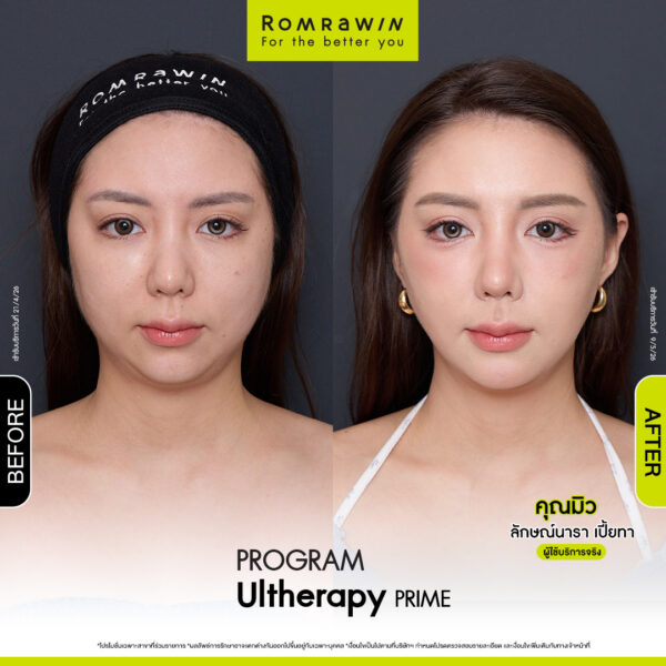 Review ulthera prime คุณมิว