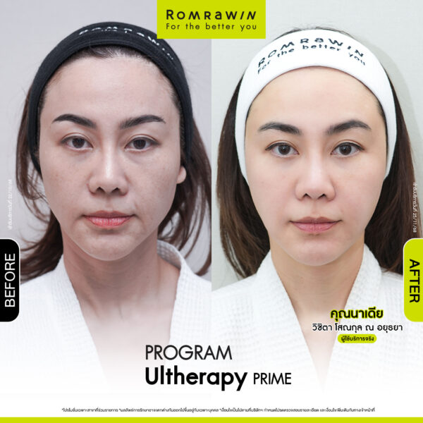 Review ulthera prime คุณนาเดียร์