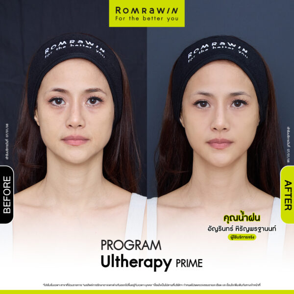 Review ulthera prime คุณน้ำฝน