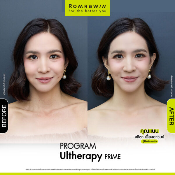 Review ulthera prime คุณแนน