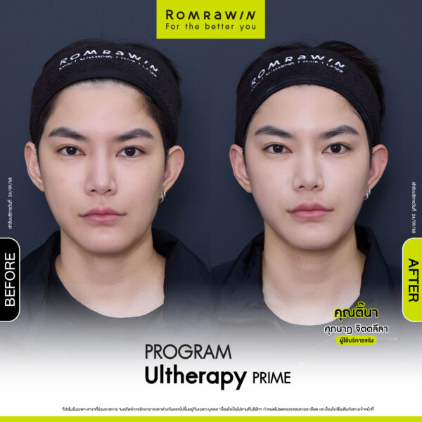 Review ulthera prime คุณติ๊นา